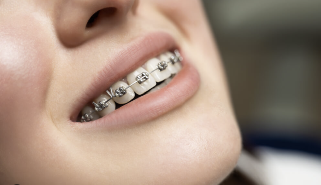 Best Orthodontists in Colleyville | Braces & Invisalign
